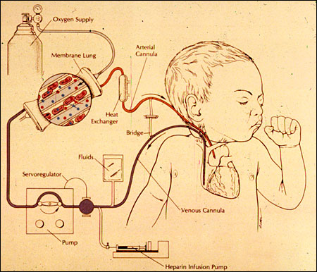 A diagram of the circuit for prolonged extracorporeal circulation