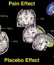 Using the brain to soften pain: the placebo effect